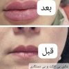 آموزش و پذیرش مدل ژل و بوتاکس