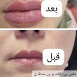 آموزش و پذیرش مدل ژل و بوتاکس