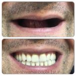 ساخت دندان مصنوعی اقتصادی!!!!!