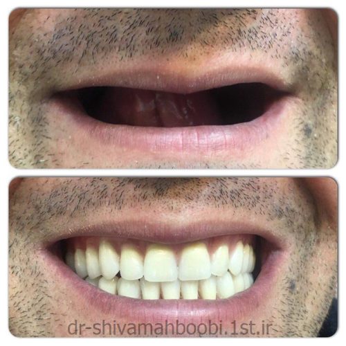 ساخت دندان مصنوعی اقتصادی!!!!!