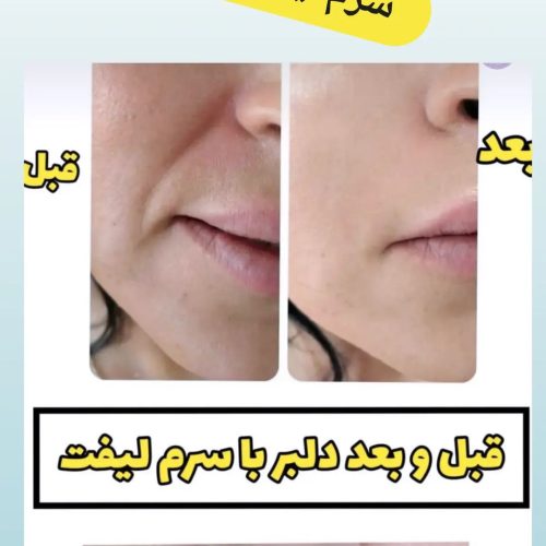 آخرین سرم مخصوص چین و چروک صورت
