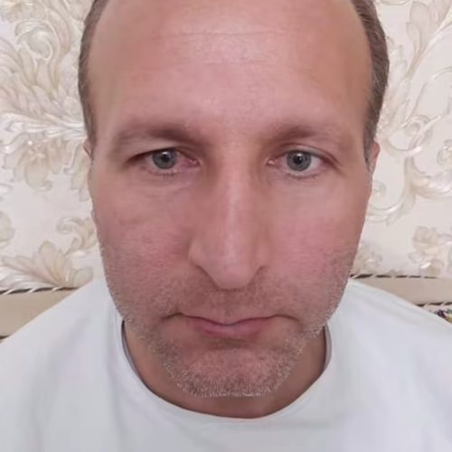 کاشت مو و کاشت ابرو (بدون جراحی)