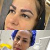 کاشت مو و کاشت ابرو (بدون جراحی)