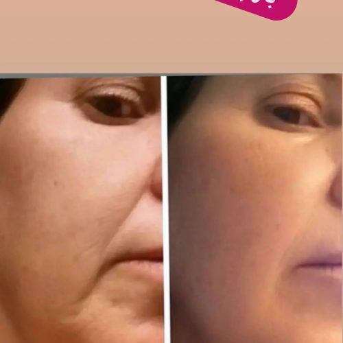 آخرین سرم مخصوص چین و چروک صورت