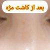 کاشت مژه و لیفت