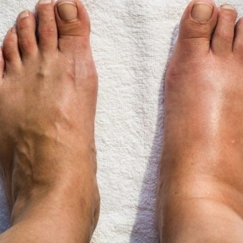 درمان بیماری های خودایمنی