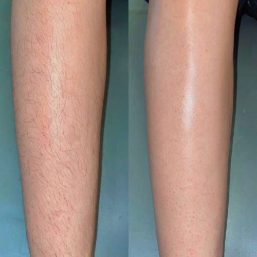 لیزر کل بدن 50درصد تخفیف