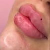انجام خدمات ژل و بوتاکس