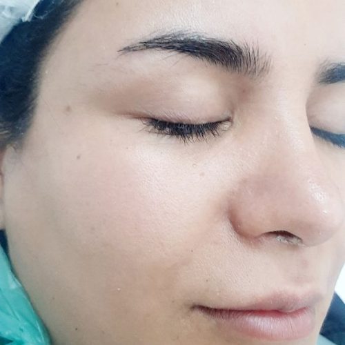 فشیال و پاکسازی پوست
