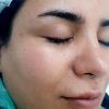 فشیال و پاکسازی پوست