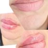 انجام خدمات ژل و بوتاکس