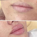انجام خدمات ژل و بوتاکس