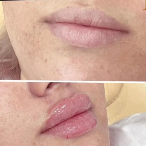 انجام خدمات ژل و بوتاکس