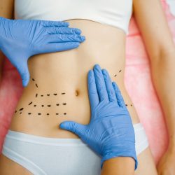 سونداژ و تعویض سوند .مراقبتهای بعد از ابدومینوپلاستی.تعویض پانسمان.ساکشن.