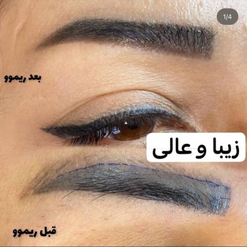لیزر موهای زائد و خالبرداری