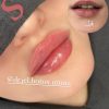 تزریق ژل و بوتاکس ارومیه