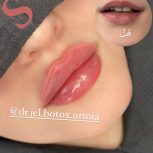 تزریق ژل و بوتاکس ارومیه