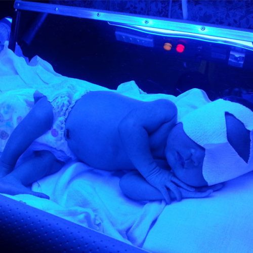 اجاره دستگاه های فتوتراپی در شهرستان بناب و حومه