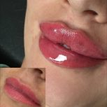 تزریق ژل و بوتاکس