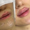 تزریق ژل و بوتاکس