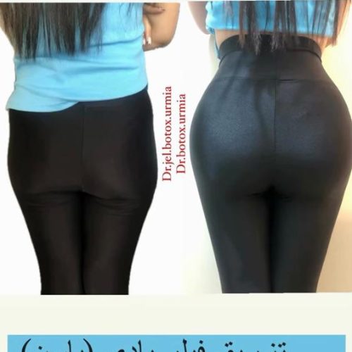 خدمات زیبایی تزریق ژل بوتاکس نخ