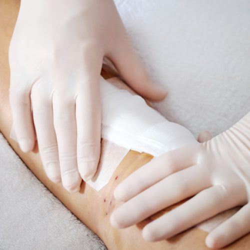 سونداژ و تعویض سوند .مراقبتهای بعد از ابدومینوپلاستی.تعویض پانسمان.ساکشن.