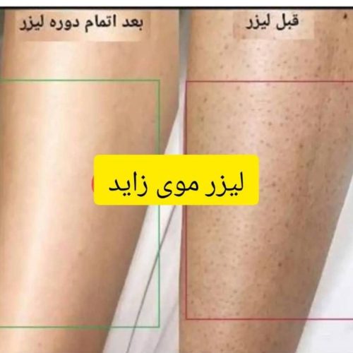 لیزر موهای زائد و خالبرداری
