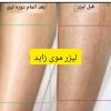 لیزر موهای زائد و خالبرداری