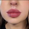 خدمات ژل و بوتاکس