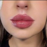 خدمات ژل و بوتاکس
