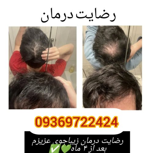 پک ریزش مو تضمینی بدون بازگشت