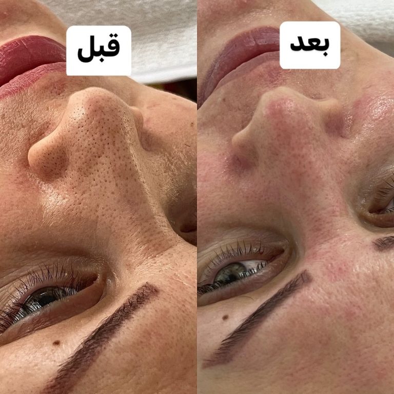 خدمات عیدانه فیشال وپاکسازی پوست همراه باآفرویژه