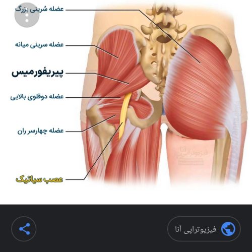 درمانگر ومشاوره دیسک وسیاتیک