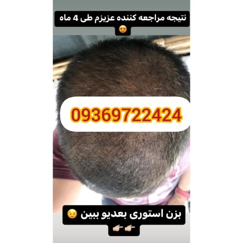 پک ریزش مو تضمینی بدون بازگشت