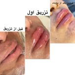 جشنواره 50درصدی فیشال،ژل و بوتاکس ،ریموو تتو صورت وبدن