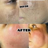 خدمات عیدانه فیشال وپاکسازی پوست همراه باآفرویژه