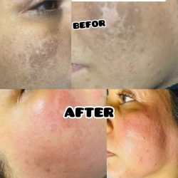 خدمات عیدانه فیشال وپاکسازی پوست همراه باآفرویژه