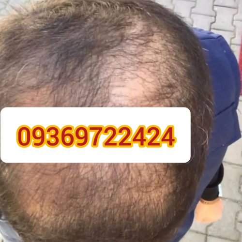پک ریزش مو تضمینی بدون بازگشت