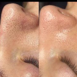 خدمات عیدانه فیشال وپاکسازی پوست همراه باآفرویژه
