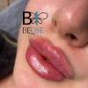 آفر ویژه ژل بوتاکس مزوتراپی prp فیلر مادلینگ سعادت آباد
