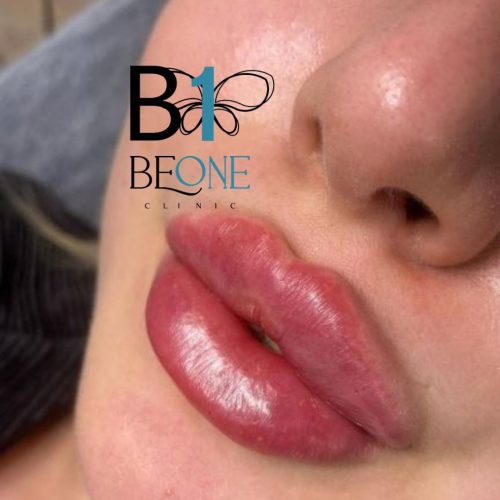 آفر ویژه ژل بوتاکس مزوتراپی prp فیلر مادلینگ سعادت آباد