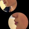 جشنواره 50درصدی فیشال،ژل و بوتاکس ،ریموو تتو صورت وبدن