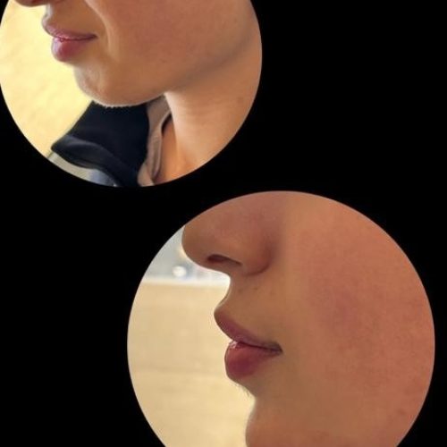 جشنواره 50درصدی فیشال،ژل و بوتاکس ،ریموو تتو صورت وبدن