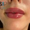 آفر ویژه ژل بوتاکس مزوتراپی prp فیلر مادلینگ سعادت آباد