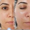 فیشیال تخصصی و پاکسازی (ویژه بانوان)