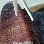 موخوره گیری مو