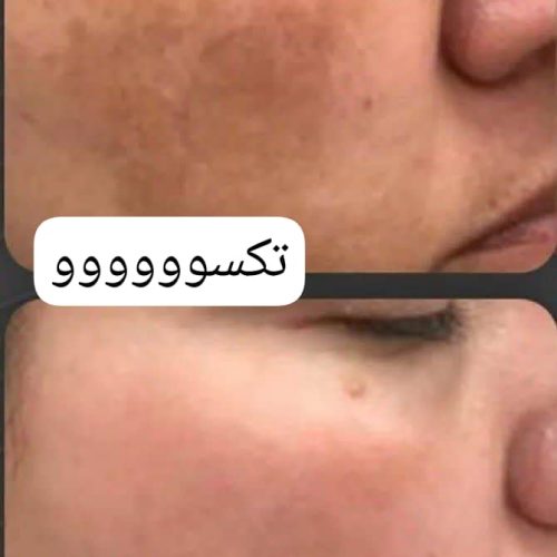 اگه میخوای پوستی صاف بدون لک جوش وبدون چروک وشاداب داشته باشی بهم پیام بده تا با مشاوره رایگان راهنمایت بکنم