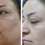 پاکسازی صورت بصورت درصدی