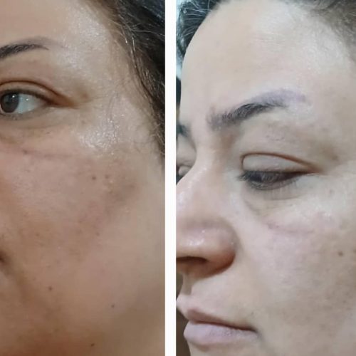 پاکسازی صورت بصورت درصدی