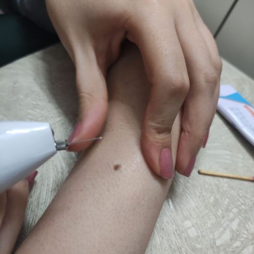 مزونیدلینگ و خالبرداری